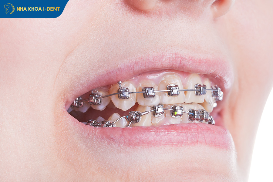 niềng răng hỏng làm răng bị quặp