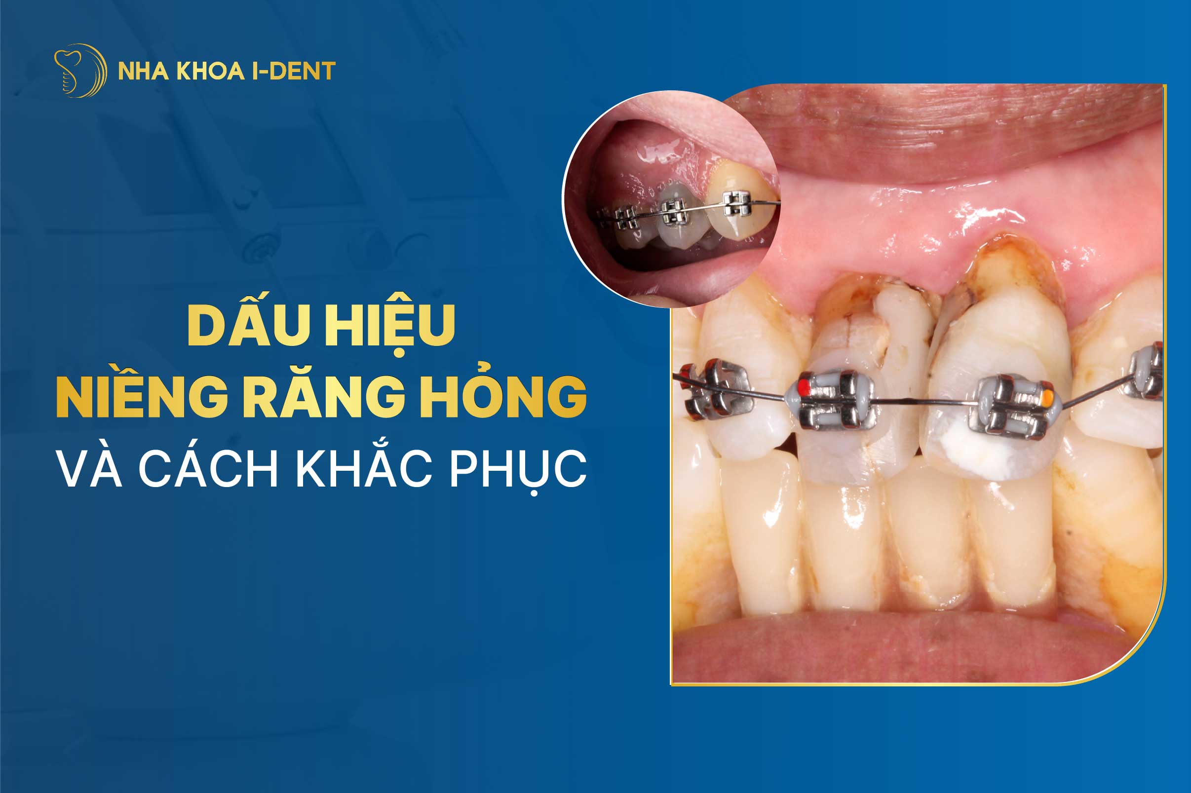 Dấu hiệu niềng răng hỏng và cách khắc phục