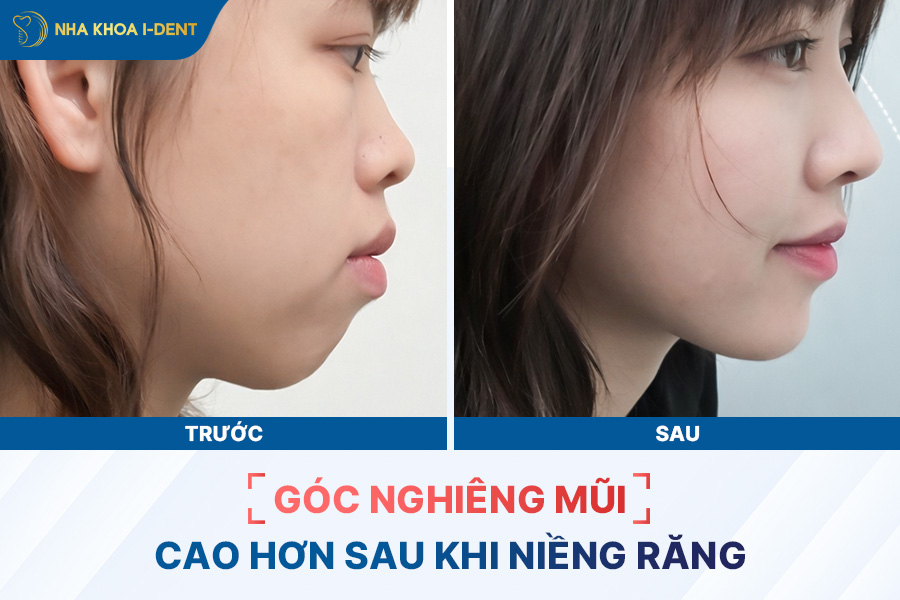 góc nghiêng trước và sau khi niềng răng