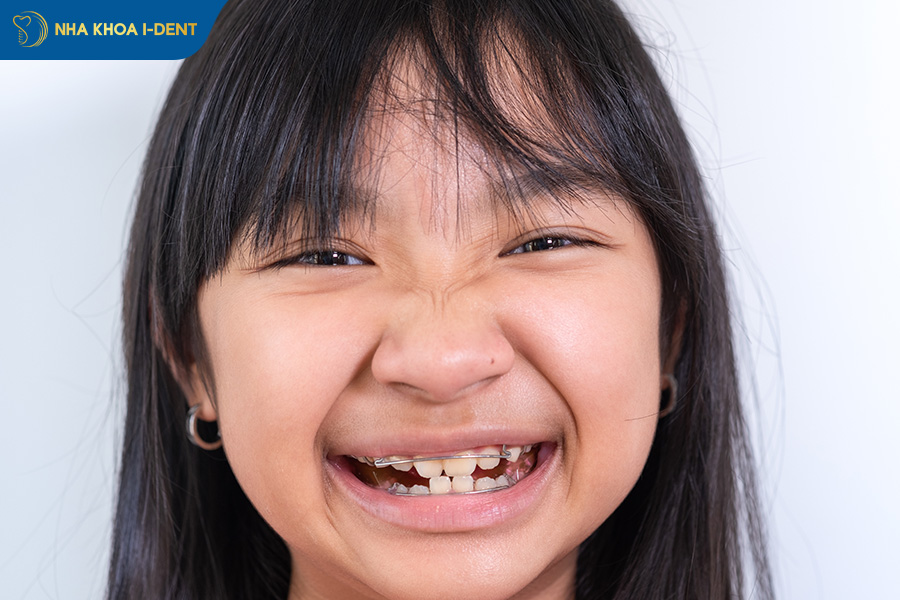 Thời gian niềng răng nhanh nhất là 14 tháng