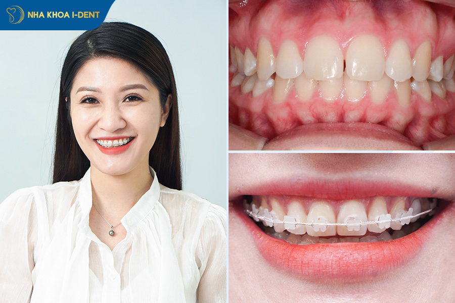 niềng răng sứ dây trong tại nha khoa i-dent