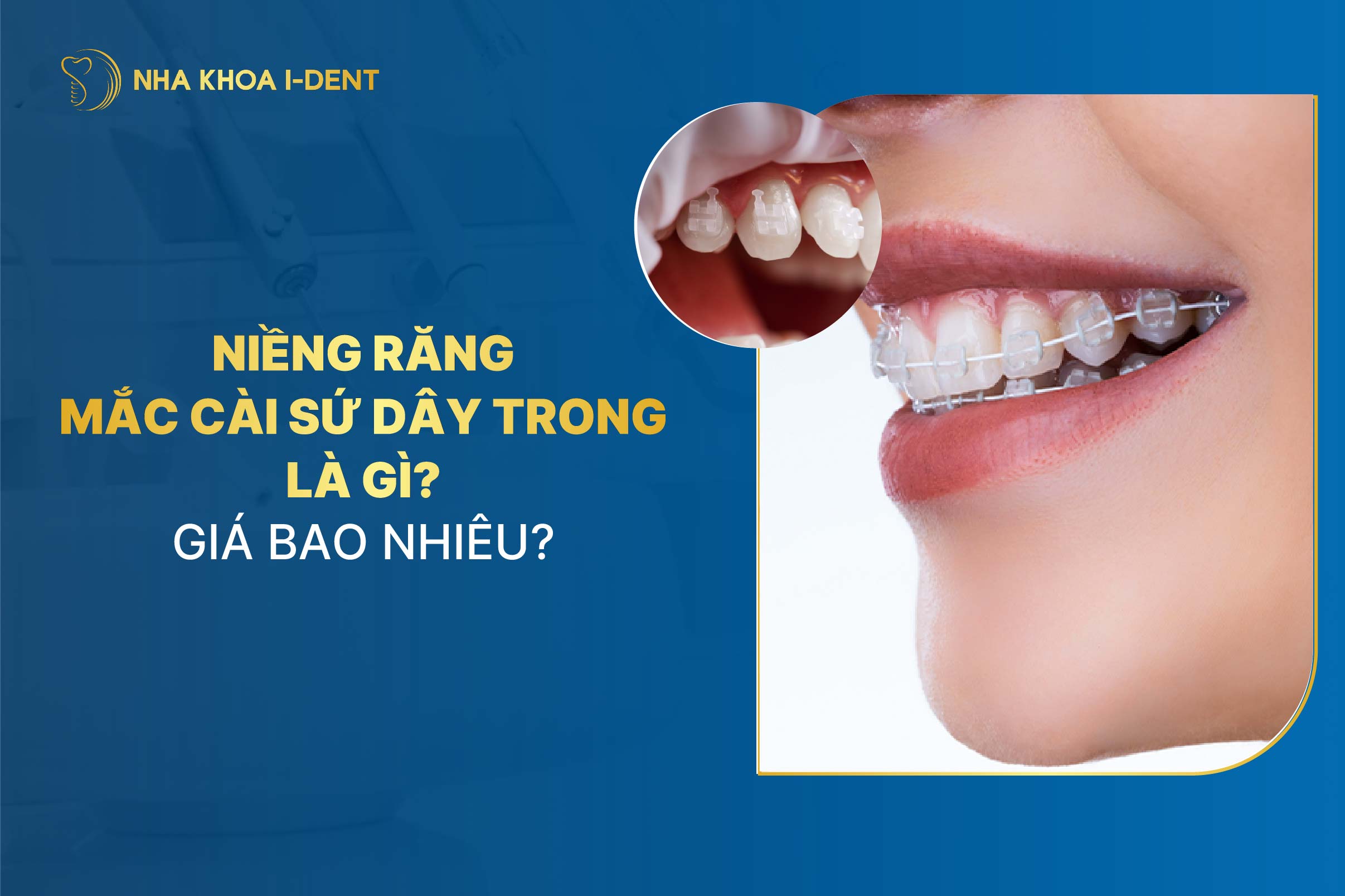 Niềng răng mắc cài sứ dây trong là gì? Giá bao nhiêu?