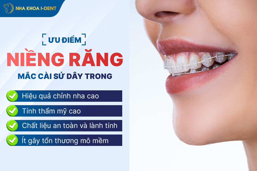 niềng răng mắc cài sứ dây trong