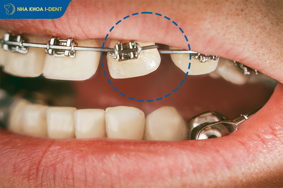 răng không di chuyển tịnh tiến mà bị nghiêng về khoảng trống