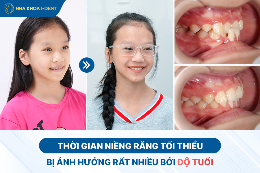 Thời gian niềng răng tối thiểu bị ảnh hưởng nhiều bởi yếu tố độ tuổi