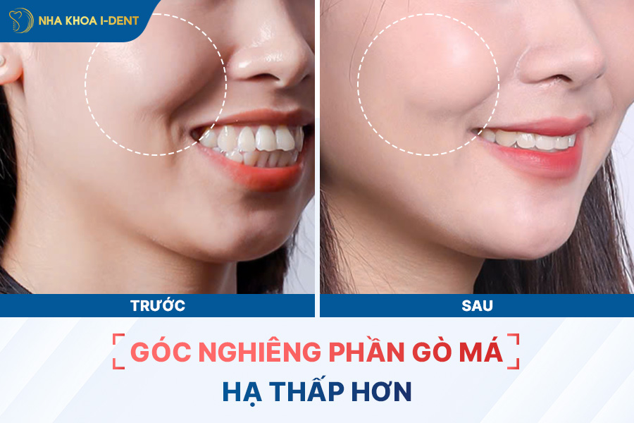 trước và sau khi niềng có thay đổi góc nghiêng