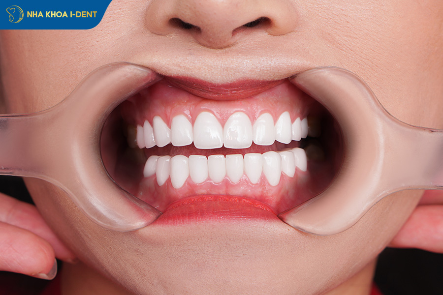 tuổi thọ của răng sứ kim loại