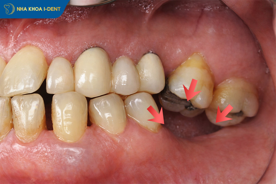 xô lệch các răng kế cận