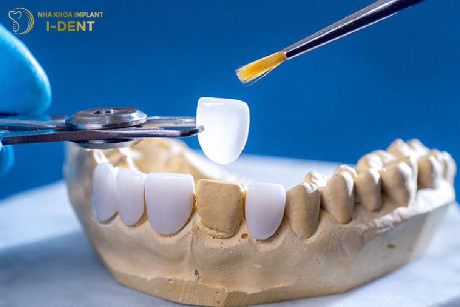 dán răng sứ có tốt không