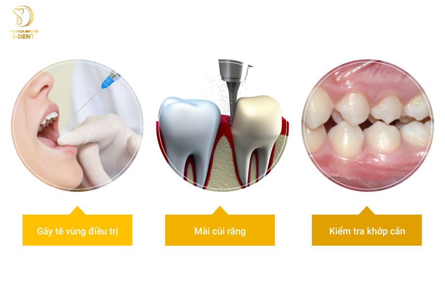 Cách bọc răng sứ