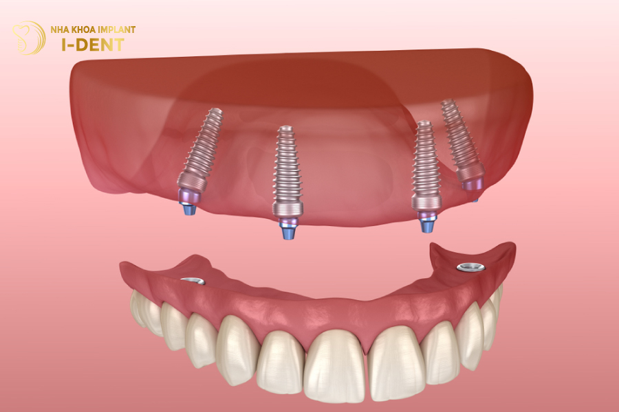 Hàm tháo lắp được lưu giữ bằng các khóa cài trực tiếp với Implant