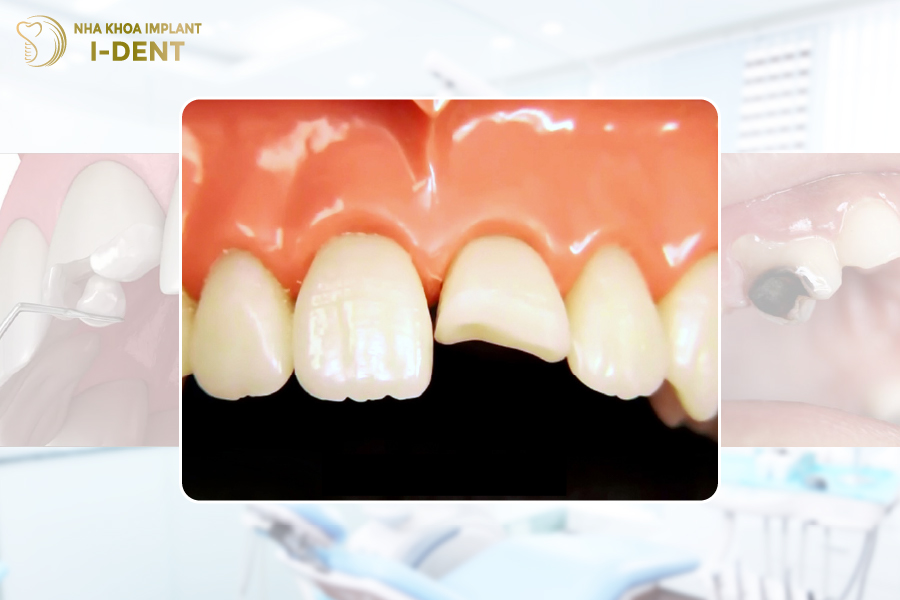 nhược điểm của dán răng sứ