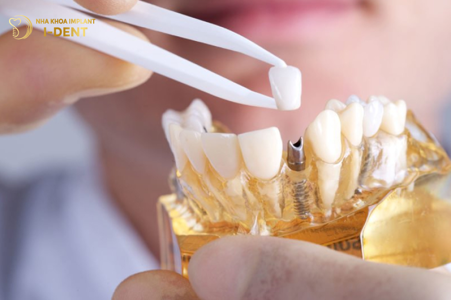 cấy ghép implant mất bao lâu