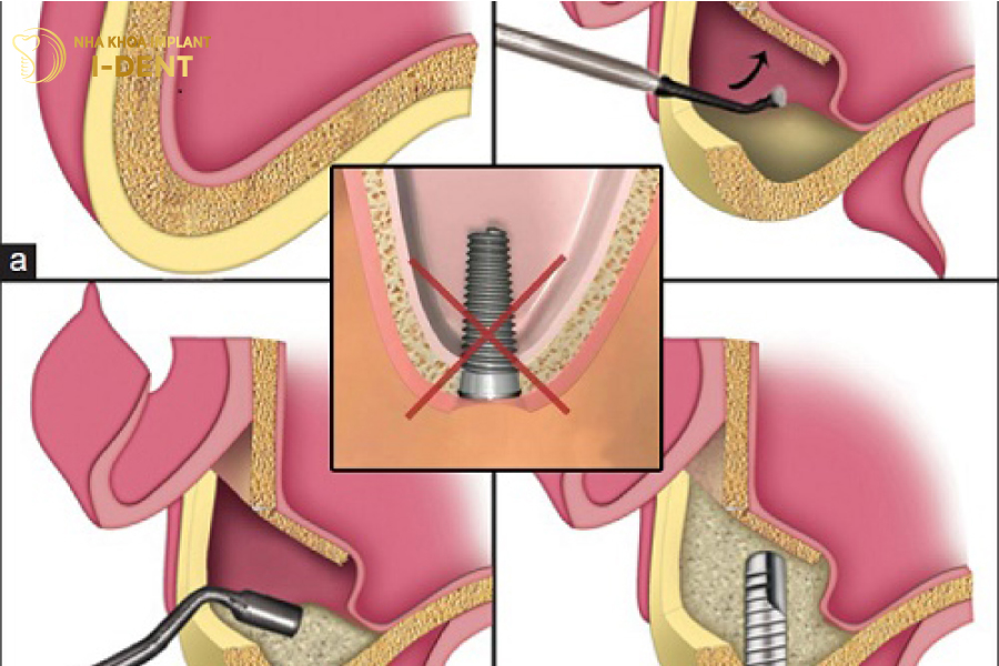 cấy implant mất bao lâu