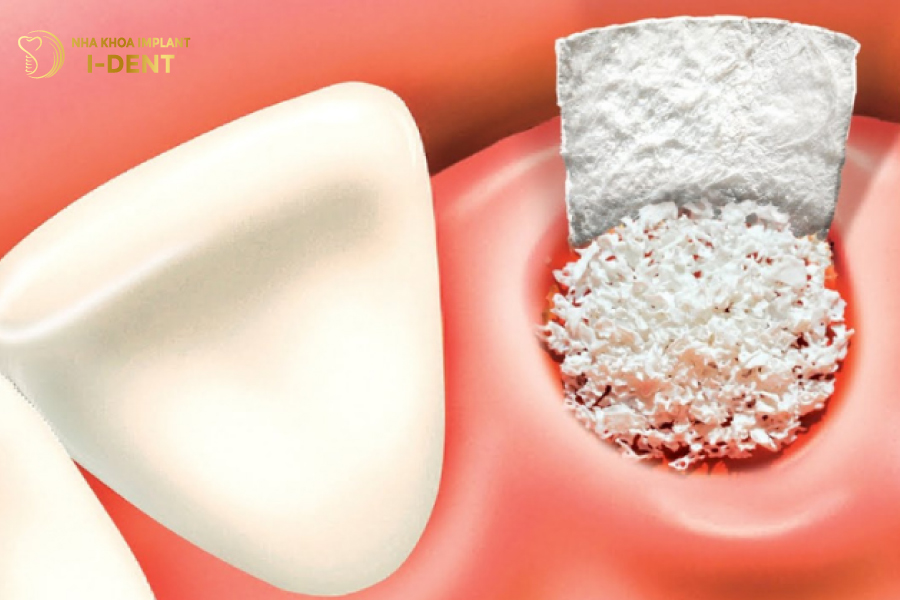 Cấy Implant xương gò má giúp hạn chế ghép xương