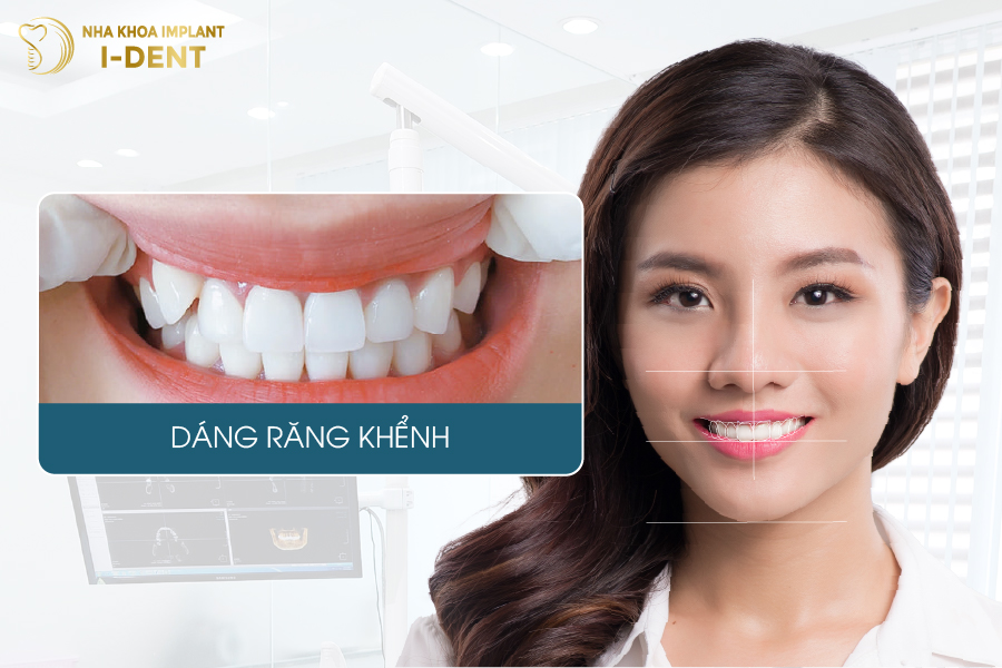 Dáng sứ răng khểnh