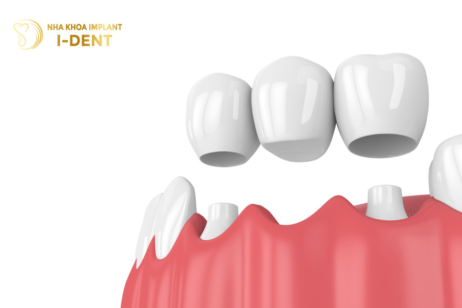 mất răng cửa có sao không