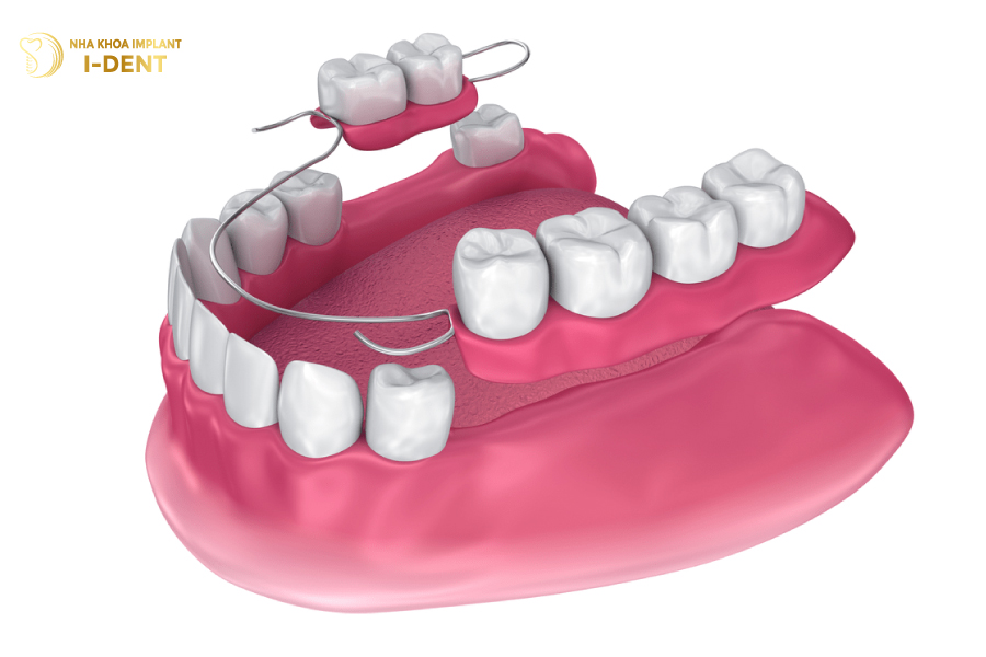 Hàm giả tháo lắp cho 4 răng liên tiếp