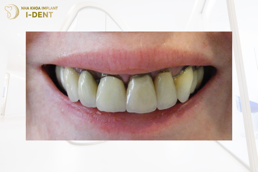 Hiện tượng viền nướu đen sau một thời gian dùng răng kim loại