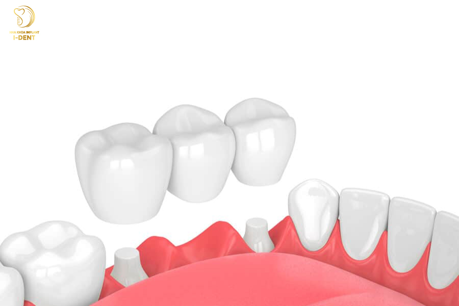 răng sứ implant