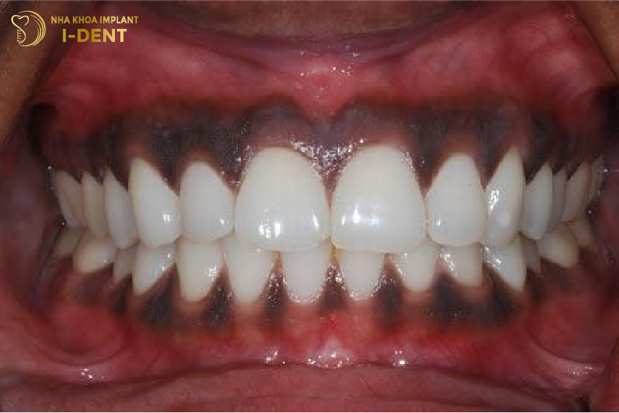 Viền nướu đổi màu