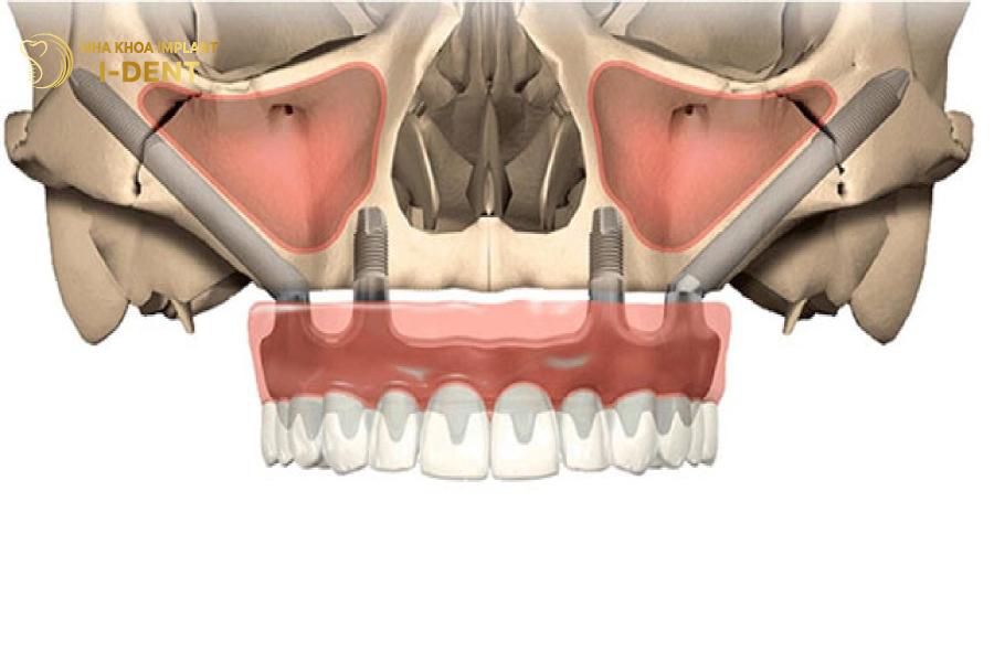 Hình dáng trụ Implant dùng để cấy xương gò má zygoma implant