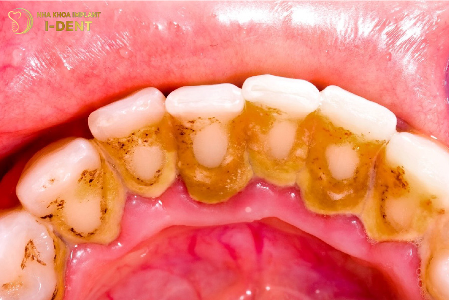 cách trị hôi miệng khi bọc răng sứ