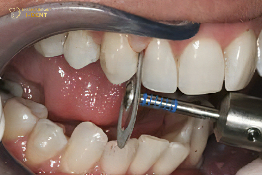 Mài kẽ răng để niềng