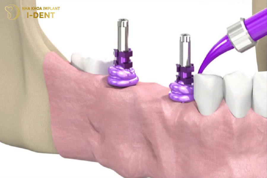 lấy dấu implant