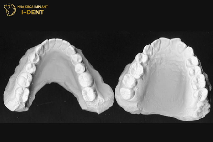 lấy dấu implant