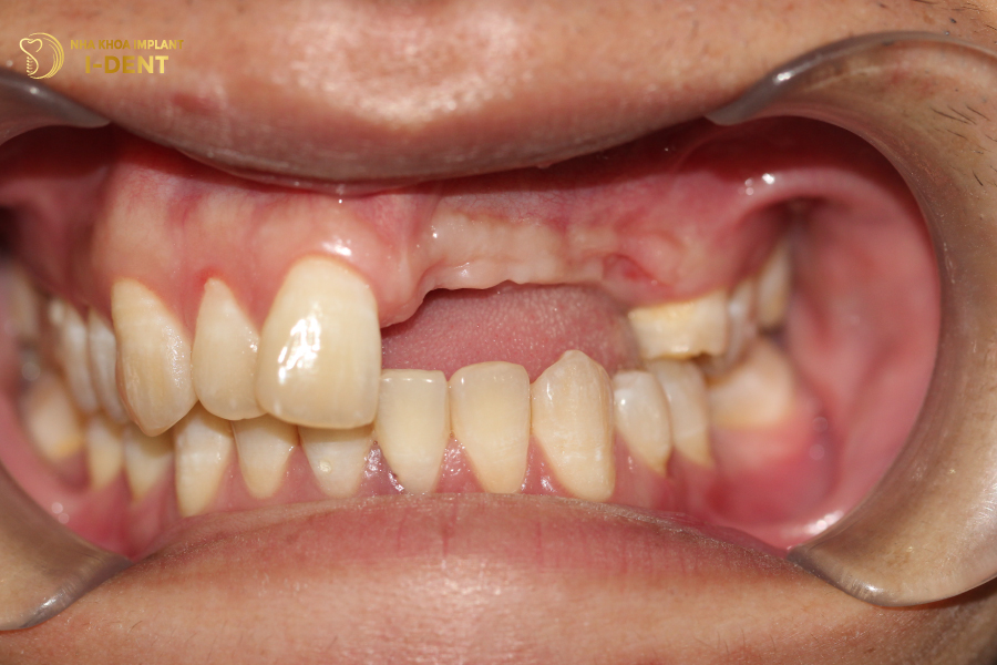  Mất 4 răng liên tiếp khiến các răng bên cạnh bị xô lệch, mọc trồi