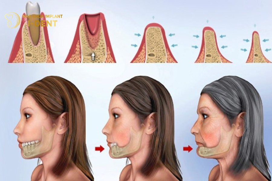 Mất chân răng sẽ dẫn đến tình trạng tiêu xương hàm