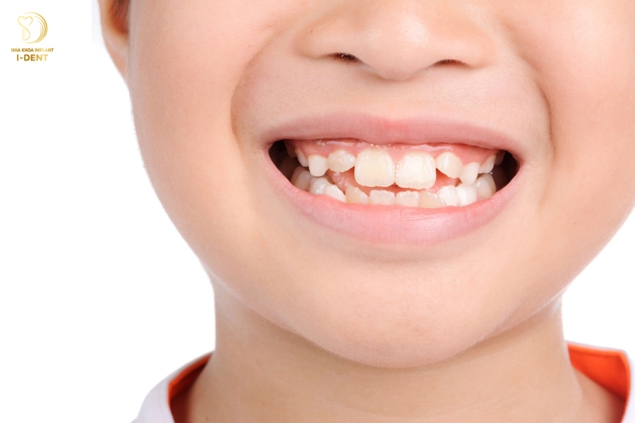 Răng lộn xộn có bọc sứ được không