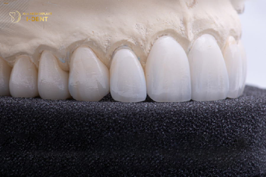 Răng sứ Cercon có độ hoàn thiện tốt