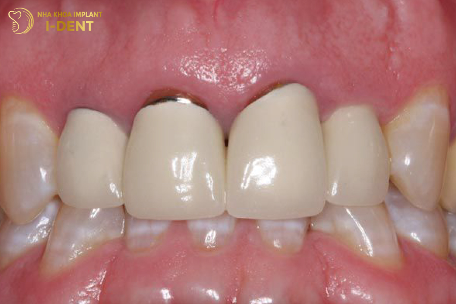 bọc răng sứ lần 2