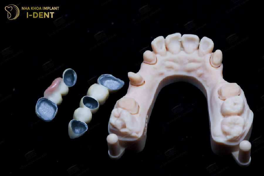 Răng sứ kim loại có khả năng chịu lực tốt