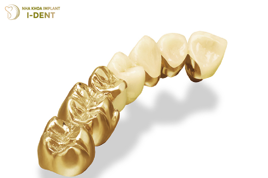 răng sứ kim loại có tốt không