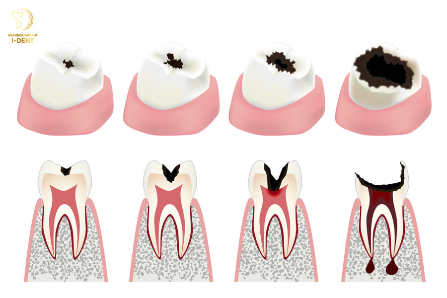 Các giai đoạn sâu răng chuyển nặng