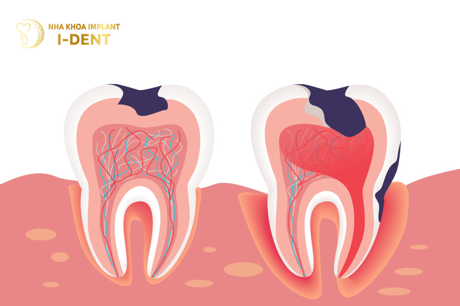 trồng răng hàm bị sâu