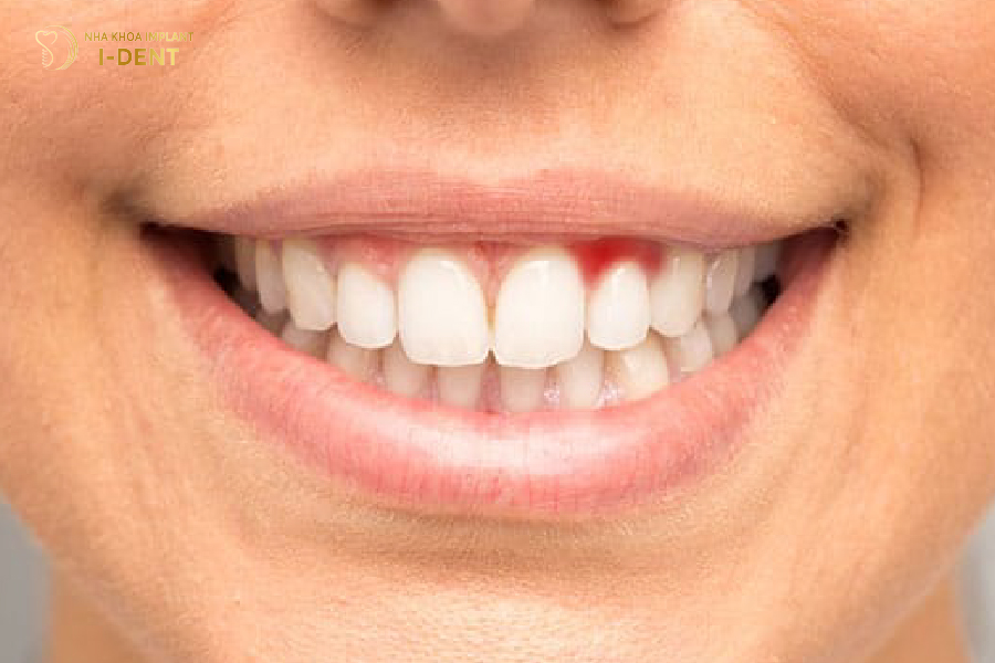 Sử dụng răng sứ kém chất lượng gây ra tình trạng viêm nướu răng