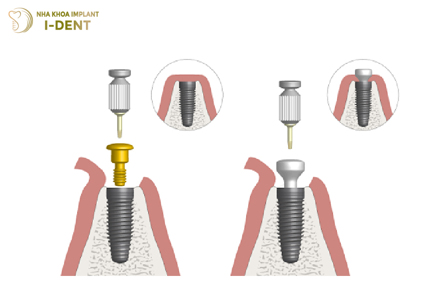 Tuổi thọ Healing Abutment tỉ lệ thuận với trụ Implant