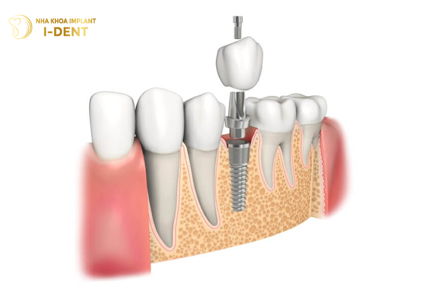 trồng răng implant được bao lâu