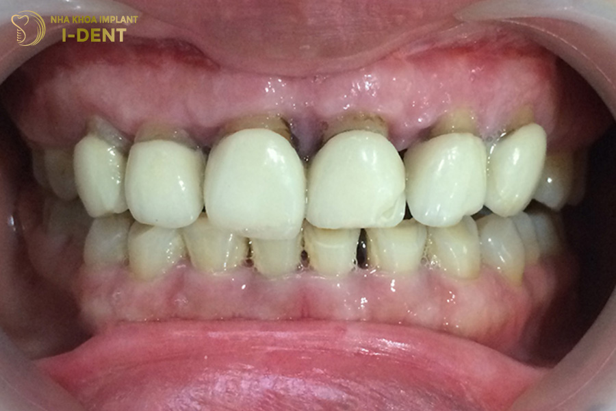 Bọc sứ bị tụt lợi