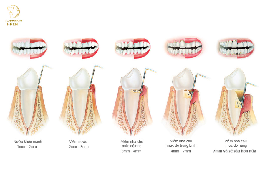 Viêm nha chu là nguyên nhân phố biến khiến răng bị lung lay