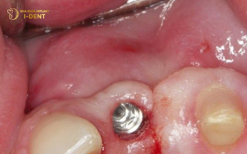 hậu quả của việc cắm trụ implant